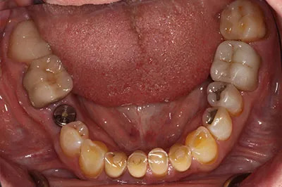 Before and After - Strobel Dentistry